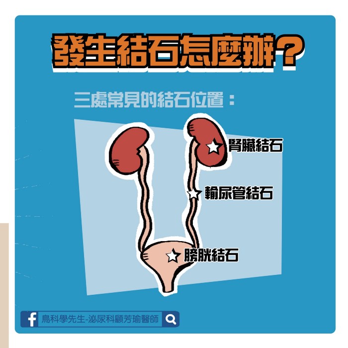常見結石位置