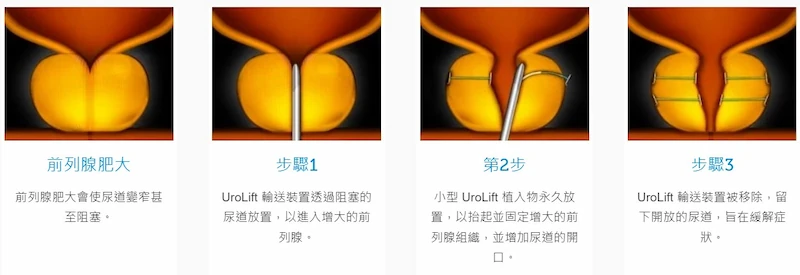 UroLift微創攝護腺拉開手術如何進行
