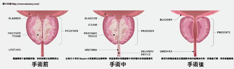 攝護腺肥大-水蒸氣消融治療