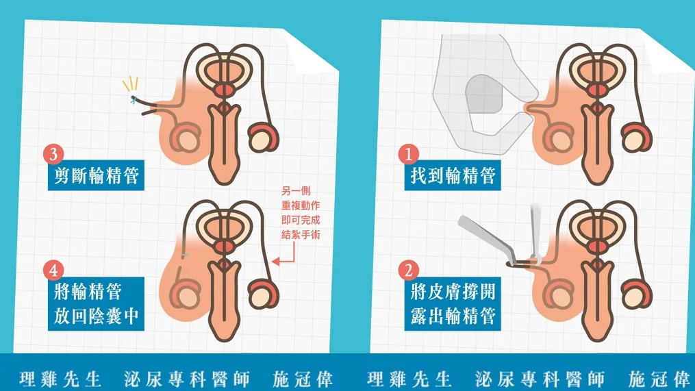 男性結紮怎麼做