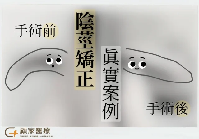 雞雞彎曲的手術效果示意,原本是左彎綜合下彎,手術後有筆直許多