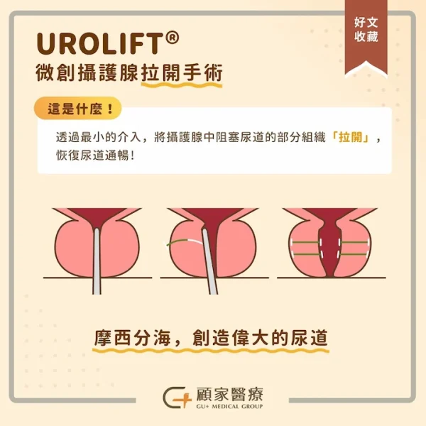 攝護腺肥大要開刀嗎,了解UROLIFT 微創攝護腺拉開手術