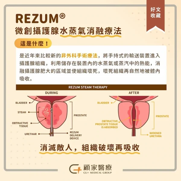 微創攝護腺水蒸氣消融療法