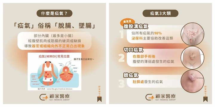 顧家醫療-到底疝氣是什麼_1