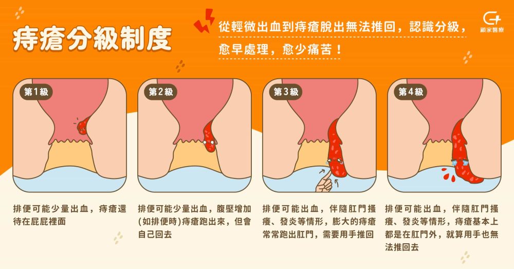 痔瘡分級找顧家醫療