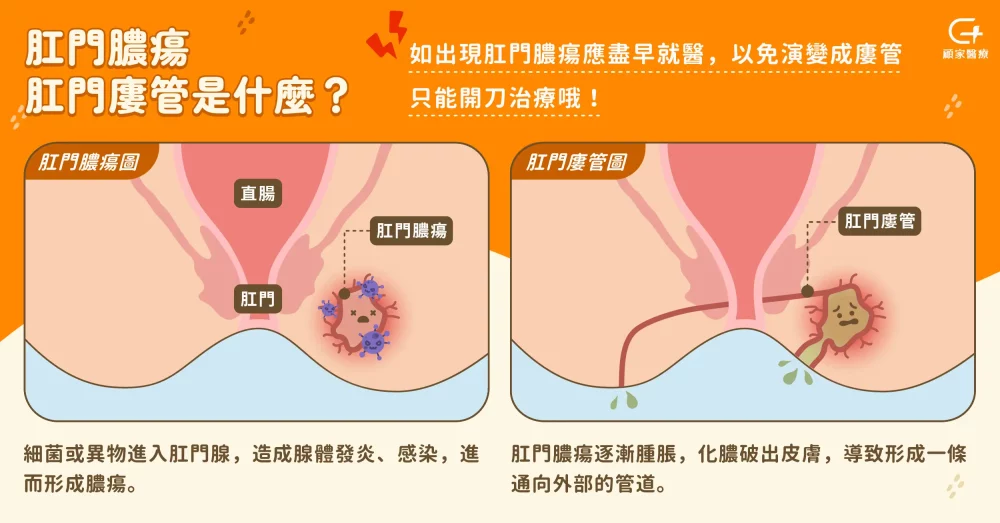 肛門膿瘍肛門廔管是什麼?