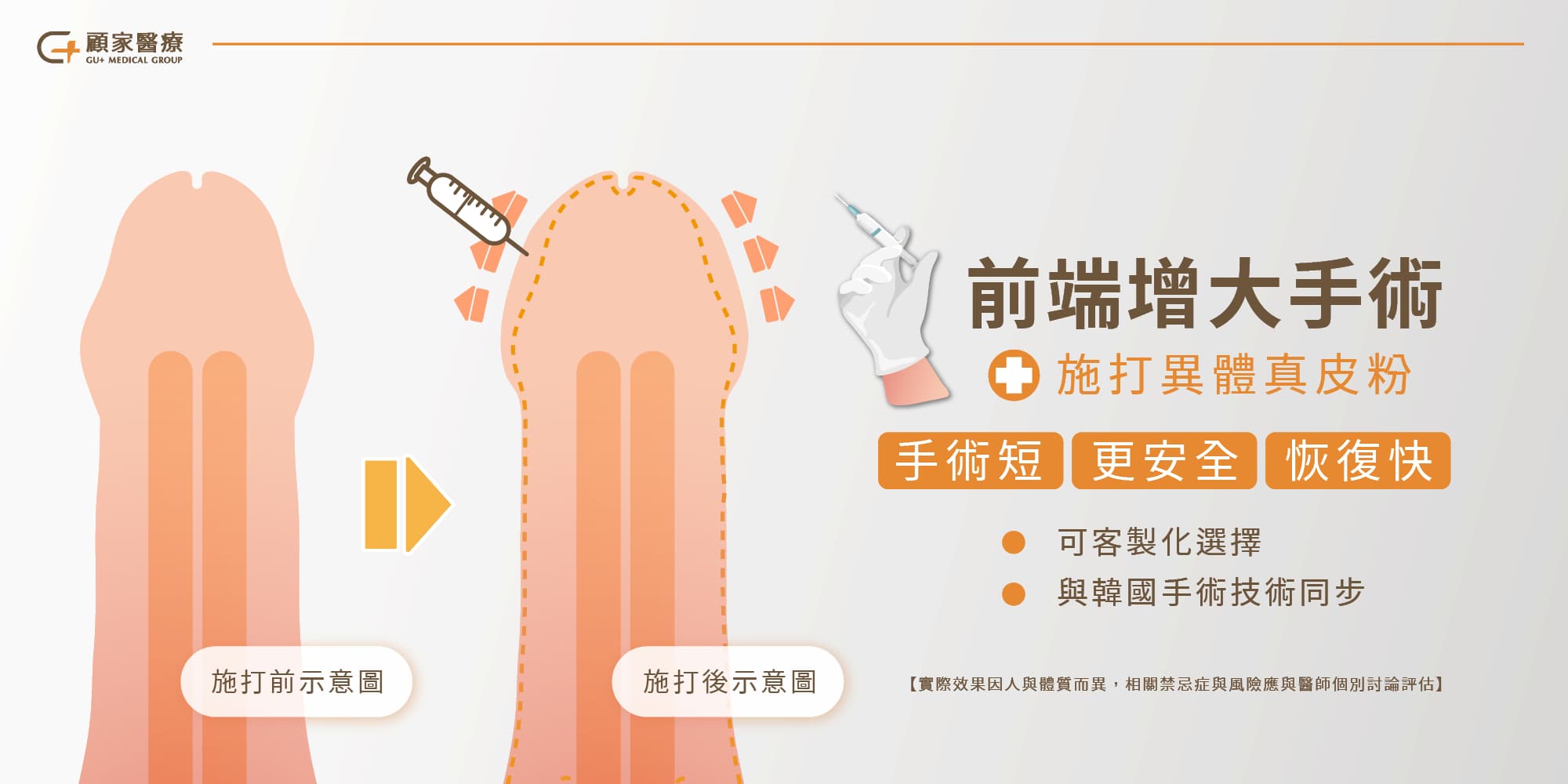 前端增大手術怎麼做