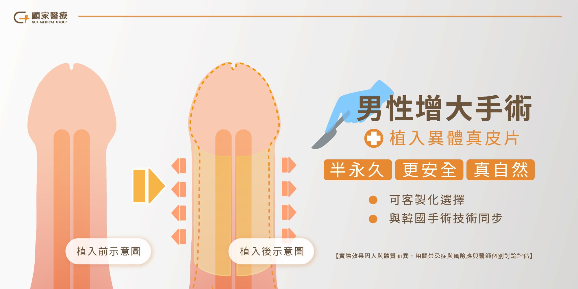 男性增大手術怎麼做