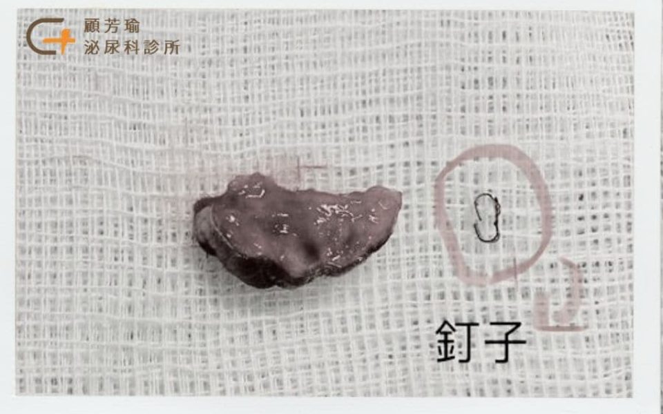 包皮槍釘子實際照片